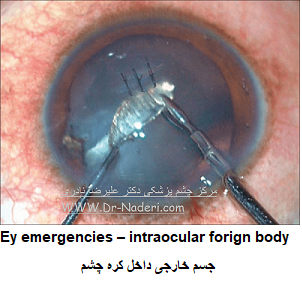 Eye emergencies - intraocular forign body جسم خارجی داخل چشم